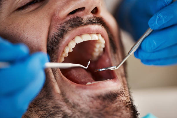 Best Emergency Wisdom Teeth Removal in Gulf Breeze, FL